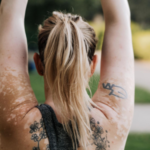 Vitiligo Treatment: Diet & Supplements Guide