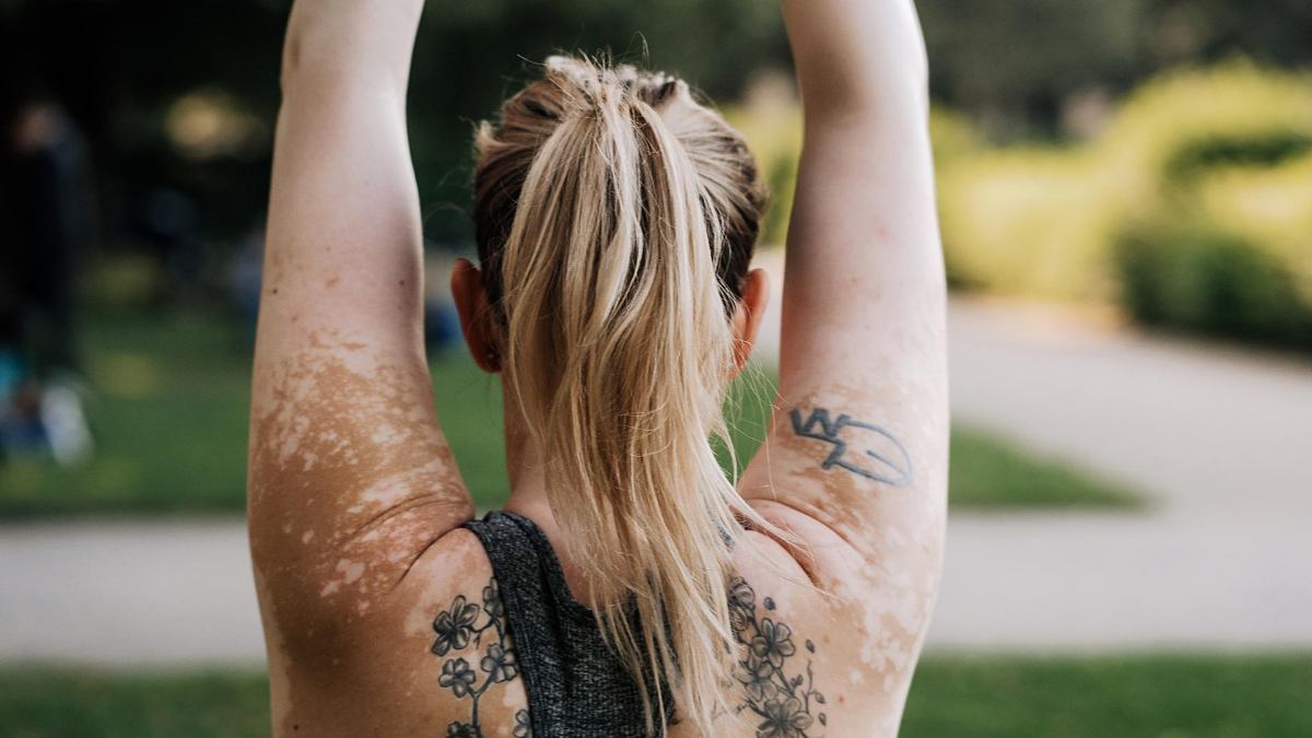 Vitiligo Treatment: Diet & Supplements Guide